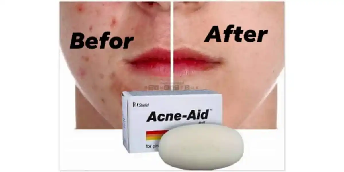 Acne Star soap( 75g)