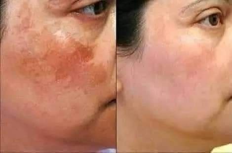 Angel melasma Cream
